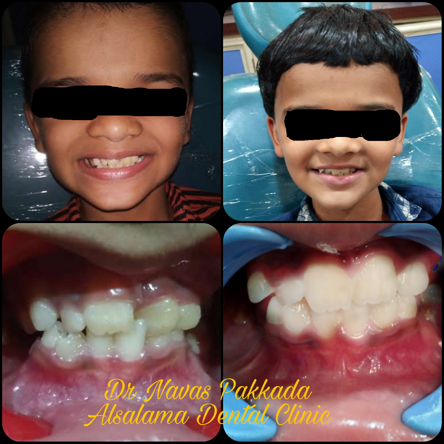 Anterior crossbite correction